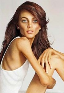 Результат диеты - анорексия