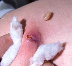 cordylobia-anthropophaga2