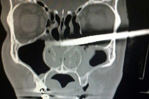 DIY Man Has Stick Removed From Eye