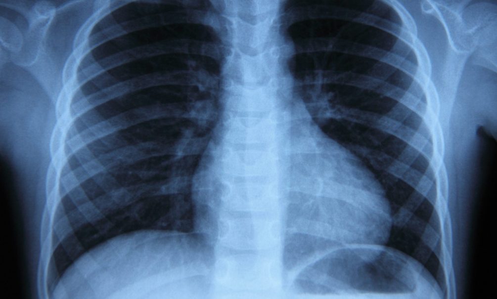 Единый регистр больных туберкулёзом создадут в России 