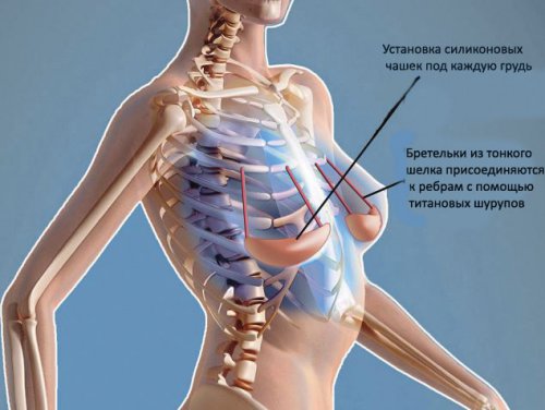 Новости пластической хирургии: грудь теперь прикрепят к ребрам 