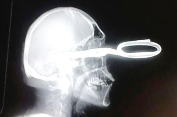 Житель Мексики пришел в больницу с ножницами в голове 