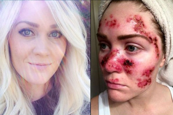 Девушка с раком кожи показала свое изуродованное лицо любителям солярия