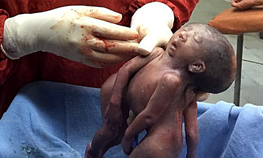Индийские врачи показали фото новорожденных близнецов с одной головой на двоих 