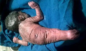 Ребенок-русалочка с размахом рук как у плавников родился в Индии