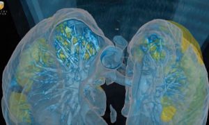 Врачи США показали, как коронавирус пожирает легкие человека