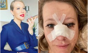 Ксения Собчак попала в больницу с переломом носа и сотрясением мозга