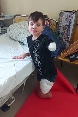 Как спустя два месяца живет 11-летний волгоградец без ног и руки после ДТП с автобусом