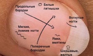 Медики назвали способы определения рака по цвету ногтей