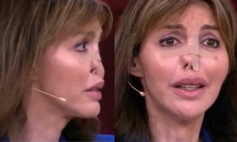 Жена аршавина без носа фото до и после