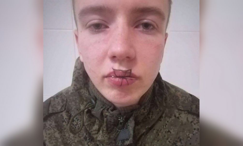 «У него просто крыша поехала»: в воинской части под Челябинском срочник зашил себе рот после ссоры с девушкой 