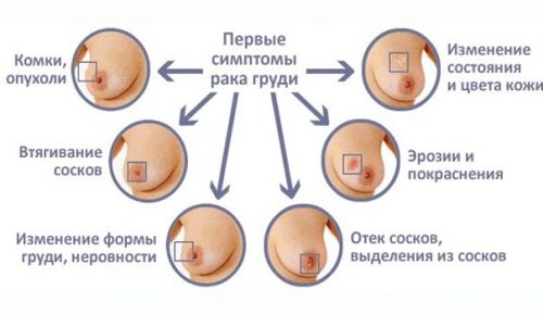 Связь между раком груди и употреблением молока нашли британские ученые