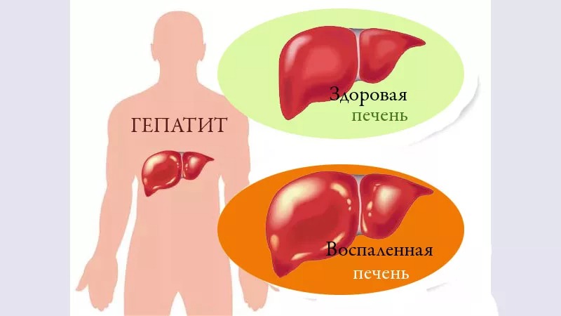 Медики зафиксировали вспышку нового поражающего печень детей вируса