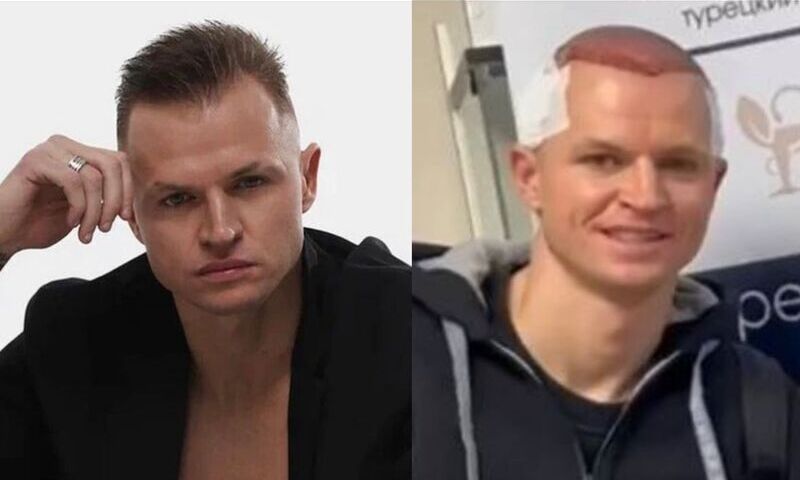 «Мисска плешь проела?»: Дмитрий Тарасов сделал операцию по пересадке волос 