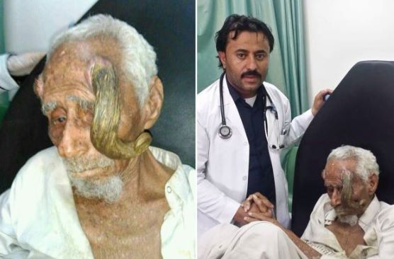 В Йемене 140-летний “человек-козел” скончался после ампутации рогов 