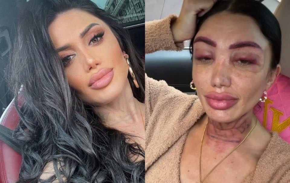 «У меня косые глаза. Я плачу»: звезду «Дома-2» Оксану Овсепян из зависти изуродовал косметолог 