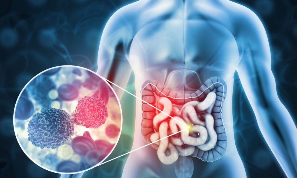 Пучит, бурлит, журчит и клокочет: врачи назвали опасные признаки вздутия живота 