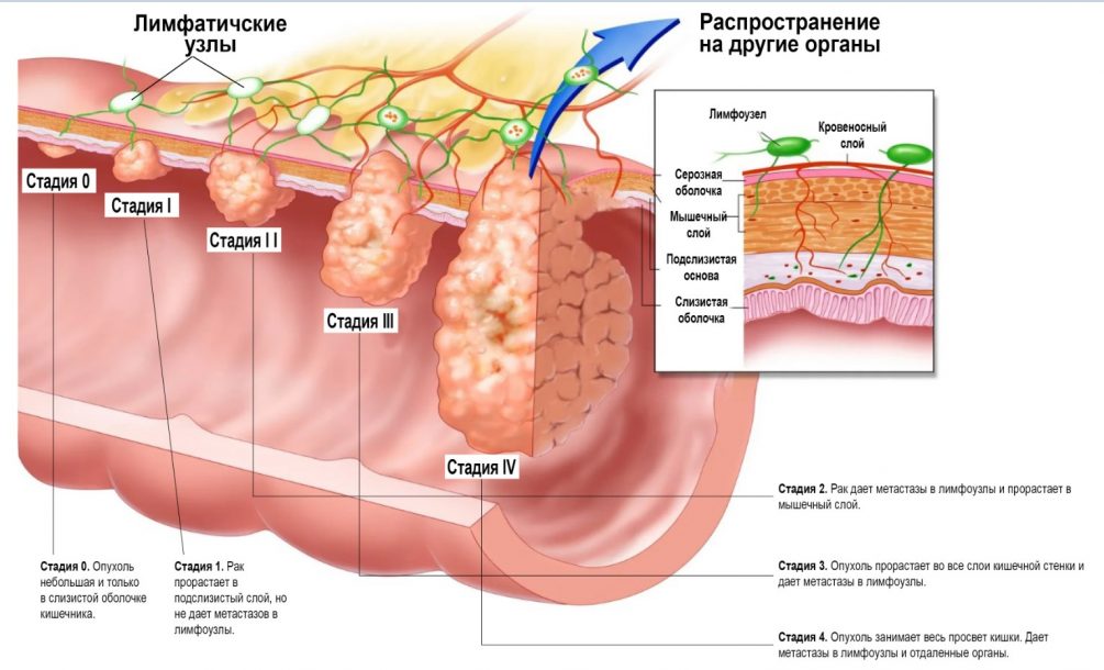 Рак кишечника симптомы причины