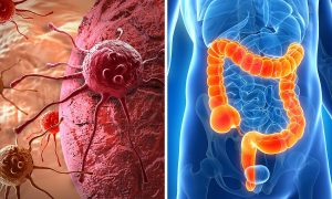 Рак кишечника: какие признаки и симптомы могут говорить о развитии онкологии