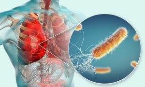 Гангрену, менингит, пневмонию, абсцесс можно получить, заразившись синегнойной палочкой в больничных условиях