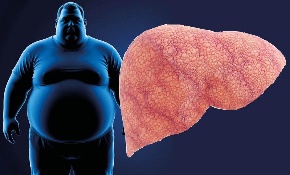 Жирная печень: опасности для жизни и здоровья, способы лечения 