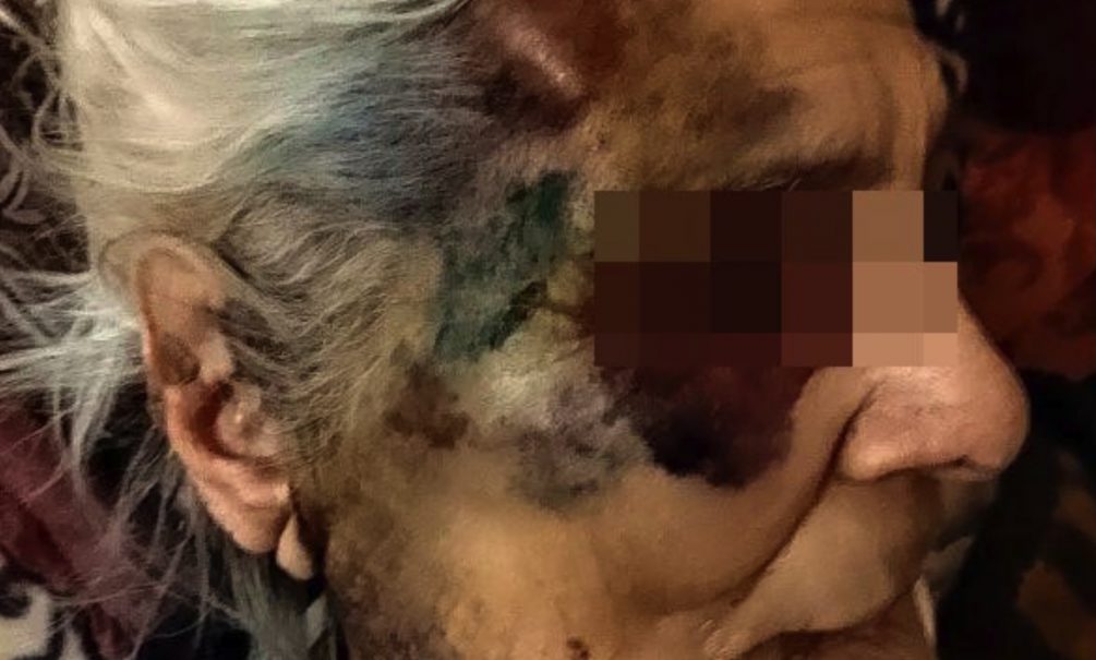 «Медпомощь оказывалась в полном объёме»: в ставропольской больнице забили 90-летнюю пенсионерку до полусмерти 