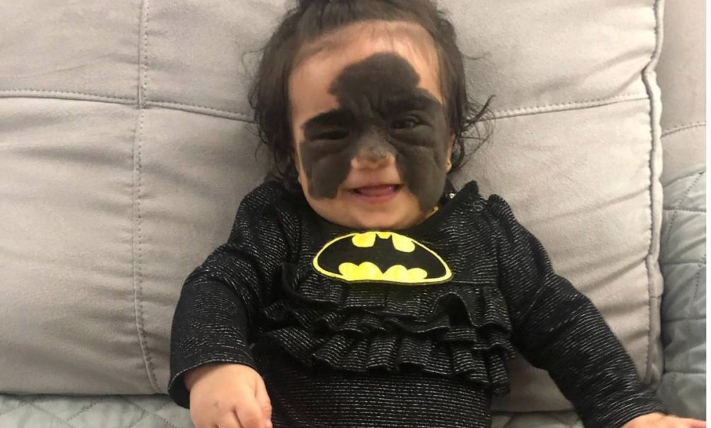 Российские врачи прооперировали четырёхлетнюю девочку из США с «маской Бэтмена» 