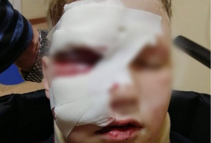 В Томске школьнику разорвало лицо взорвавшейся пивной кегой 