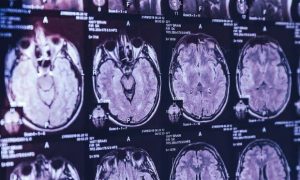 Власти Канады запретили ученым исследовать загадочную болезнь мозга