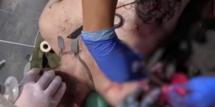 «Без ноги прошёл километр до медиков»: тяжелораненый разведчик ножницами отрезал руку, чтобы выжить
