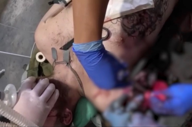 «Без ноги прошёл километр до медиков»: тяжелораненый разведчик ножницами отрезал руку, чтобы выжить 