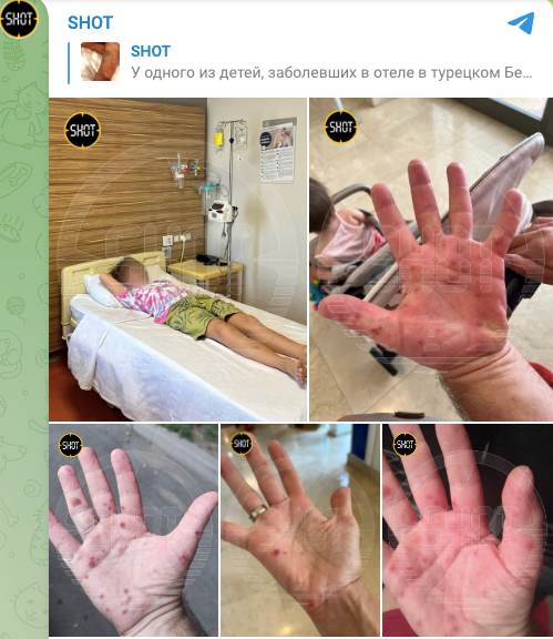 Из Турции с «сюрпризом»: российские туристы возвращаются из отпуска с симптомами заражения мощным вирусом