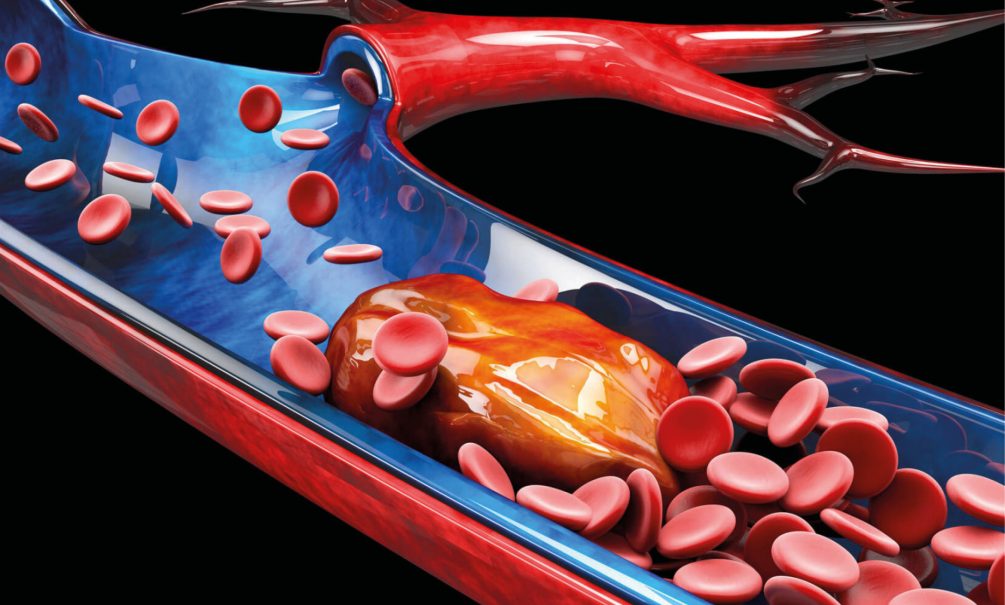 Транзит крови перекрыт тромбами: симптомы и кто в группе риска 