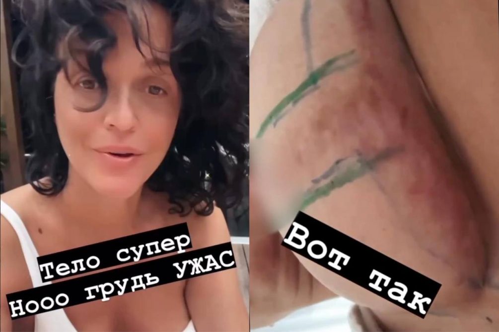 Попа, как у Ким и жуткие рубцы: российские звезды, ставшие жертвами неудачной пластики