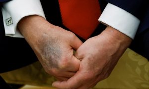 Вот почему Трамп спешит со сделкой по Украине: синяки на руках президента все больше – врачи считают, что Дональду осталось полгода