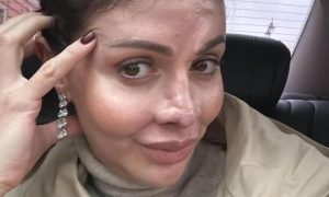 Бывшей жене Аршавина восстановили утраченный нос - опубликованы шокирующие кадры после операции