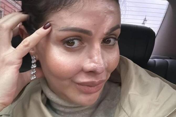 Бывшей жене Аршавина восстановили утраченный нос - опубликованы шокирующие кадры после операции 