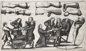 Раненых солдат ВСУ косит гангрена: все хуже, чем в Первую и Вторую мировые