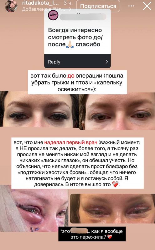 «Не получилось убрать дыру в щеке»: ставшая жертвой пластики Рита Дакота показала лицо после повторной операции