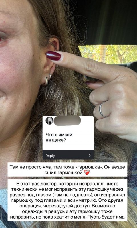 «Не получилось убрать дыру в щеке»: ставшая жертвой пластики Рита Дакота показала лицо после повторной операции