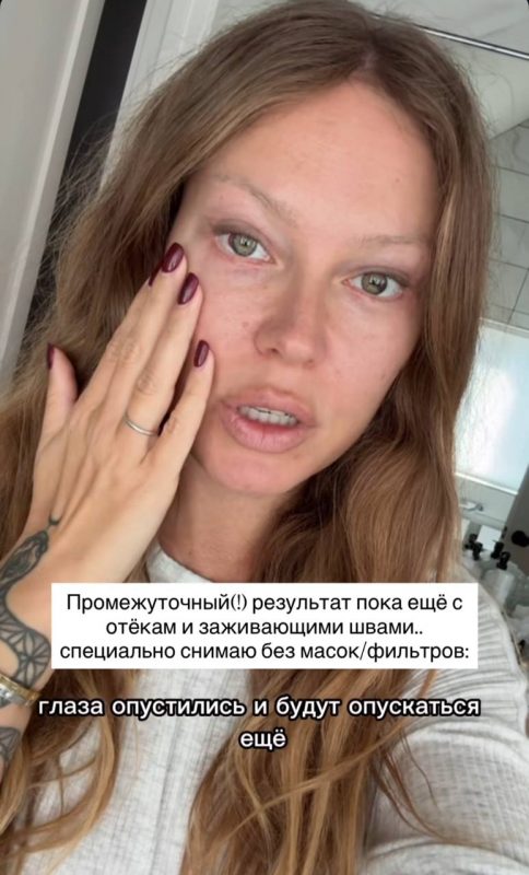 «Не получилось убрать дыру в щеке»: ставшая жертвой пластики Рита Дакота показала лицо после повторной операции