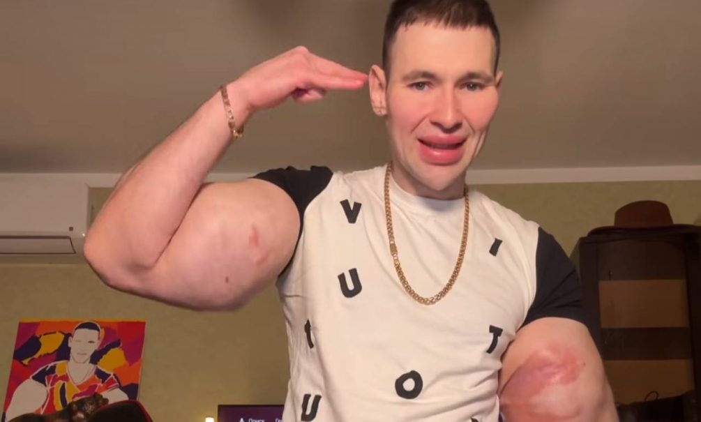 «Руки-Базуки» почернели и гниют: Кирилл Терешин может лишиться конечностей «Руки-Базуки» почернели и гниют: Кирилл Терешин может лишиться конечностей