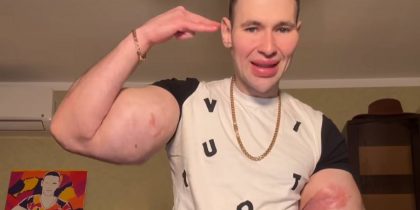 «Руки-Базуки» почернели и гниют: Кирилл Терешин может лишиться конечностей