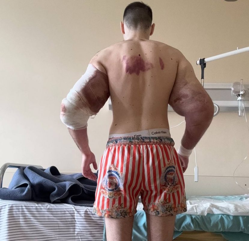 «Руки-Базуки» почернели и гниют: Кирилл Терешин может лишиться конечностей