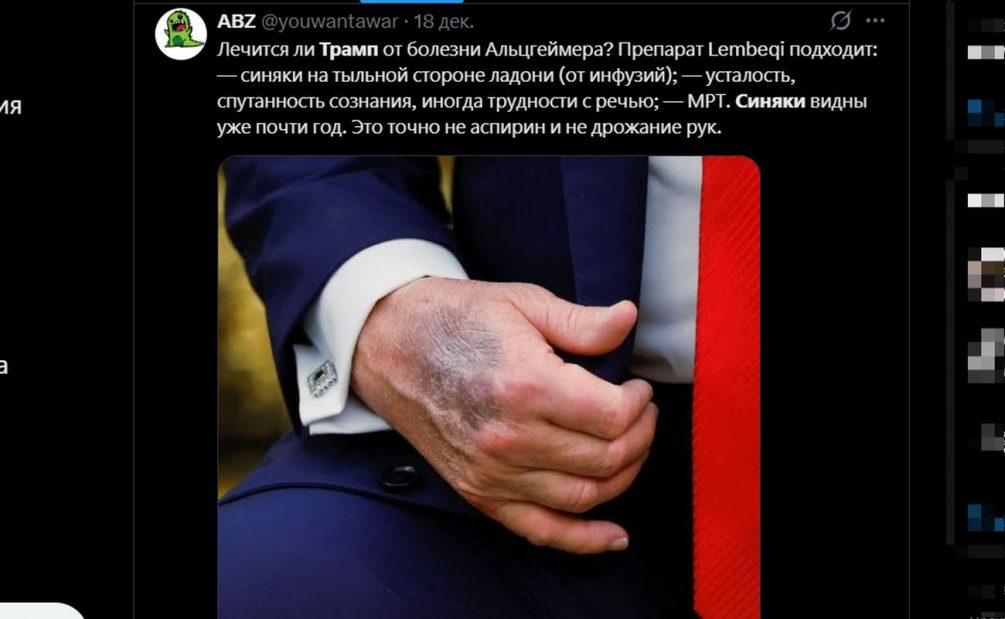 Синяки Трампа на Рождество взбудоражили США: что скрывает президент