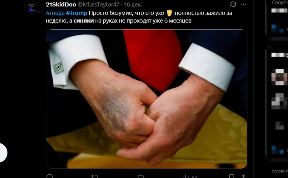 Синяки Трампа на Рождество взбудоражили США: что скрывает президент