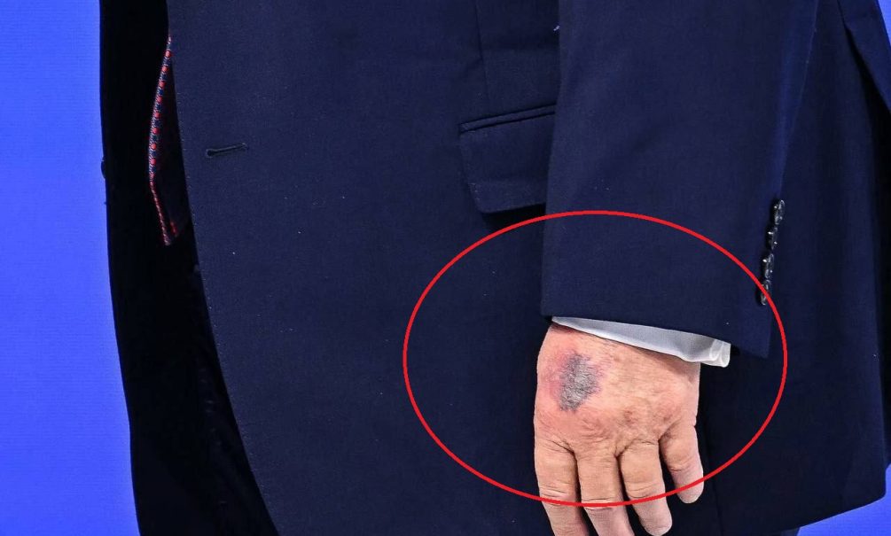 Трампу осталось недолго: на руках президента США снова появились жуткие синяки Трампу осталось недолго: на руках президента США снова появились жуткие синяки