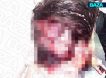 Белый медведь содрал кожу на голове вахтовика на Таймыре - есть жуткие кадры последствий нападения