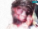 Белый медведь содрал кожу на голове вахтовика на Таймыре - есть жуткие кадры последствий нападения