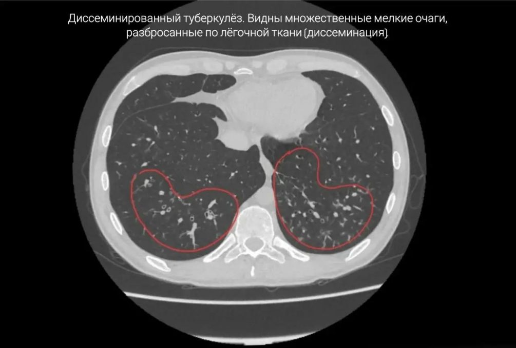 Мужчина из Приморья умер из-за осложнений, появившихся у него после 17 лет курения вейпов